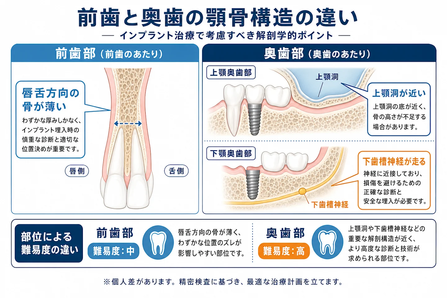 前歯と奥歯の顎骨構造の違いを示す解剖図(前歯は骨が薄く、奥歯は上顎洞・下歯槽神経に注意)