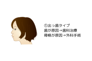 出っ歯タイプの口ゴボ