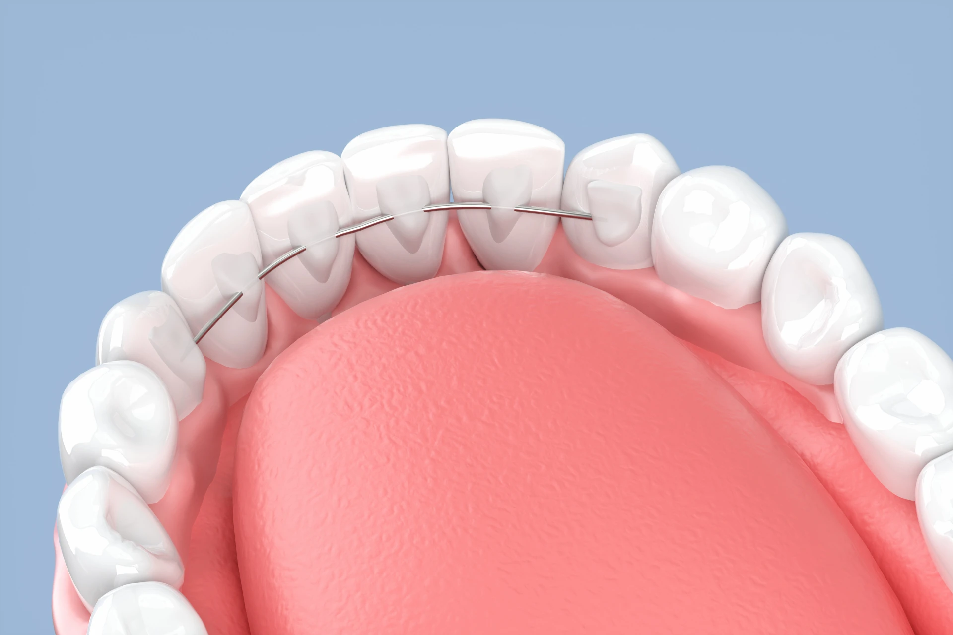 裏側矯正で出っ歯は治せる?メリットやできないケース、期間や費用を解説!