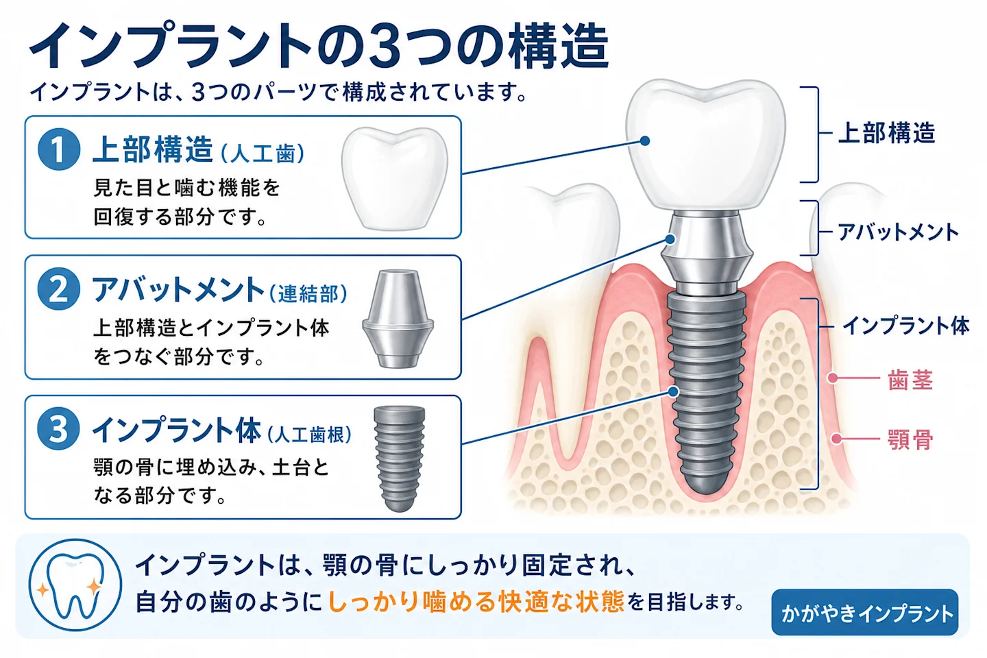 インプラントの3つの構造(インプラント体・アバットメント・上部構造)を示す断面図