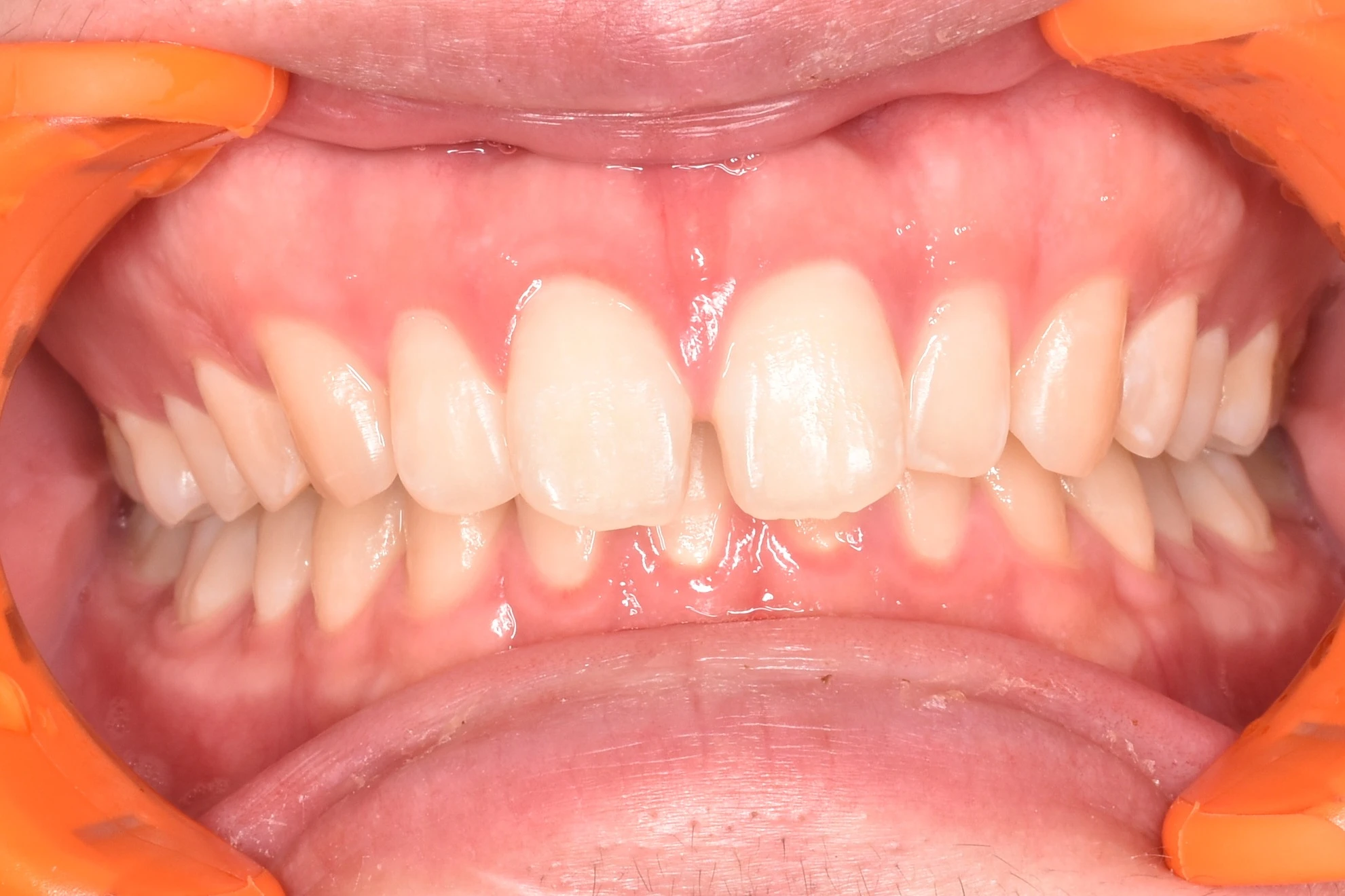 Before Image