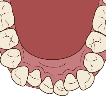 叢生の下顎歯列