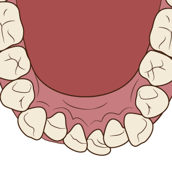 叢生とはどんな歯並び？原因や治療法、費用も併せて解説