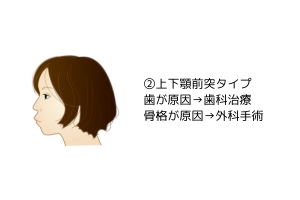上下顎前突タイプの口ゴボ