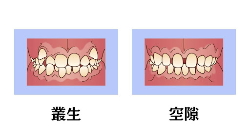 叢生と空隙のイラスト