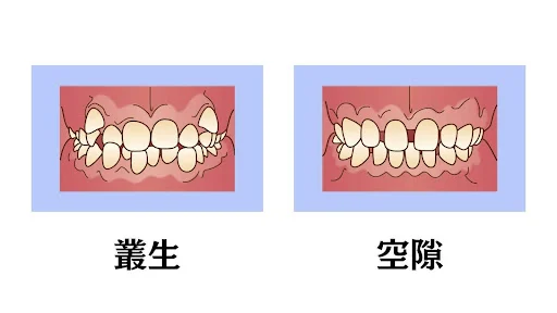 叢生と空隙のイラスト