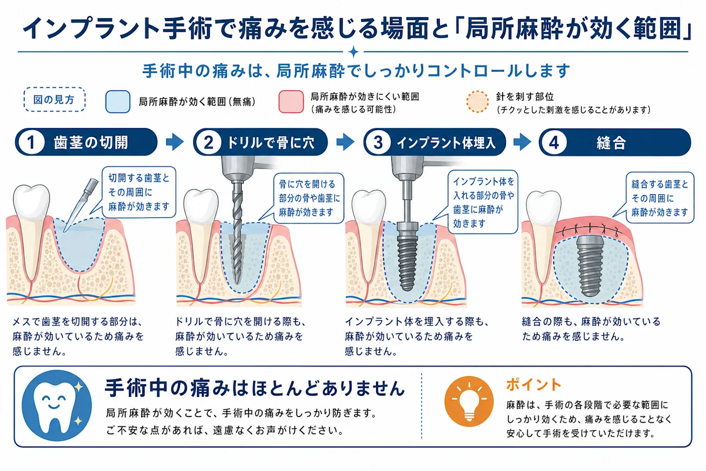インプラント手術で局所麻酔が効く範囲と痛みを感じない仕組みを示した口腔断面の図解