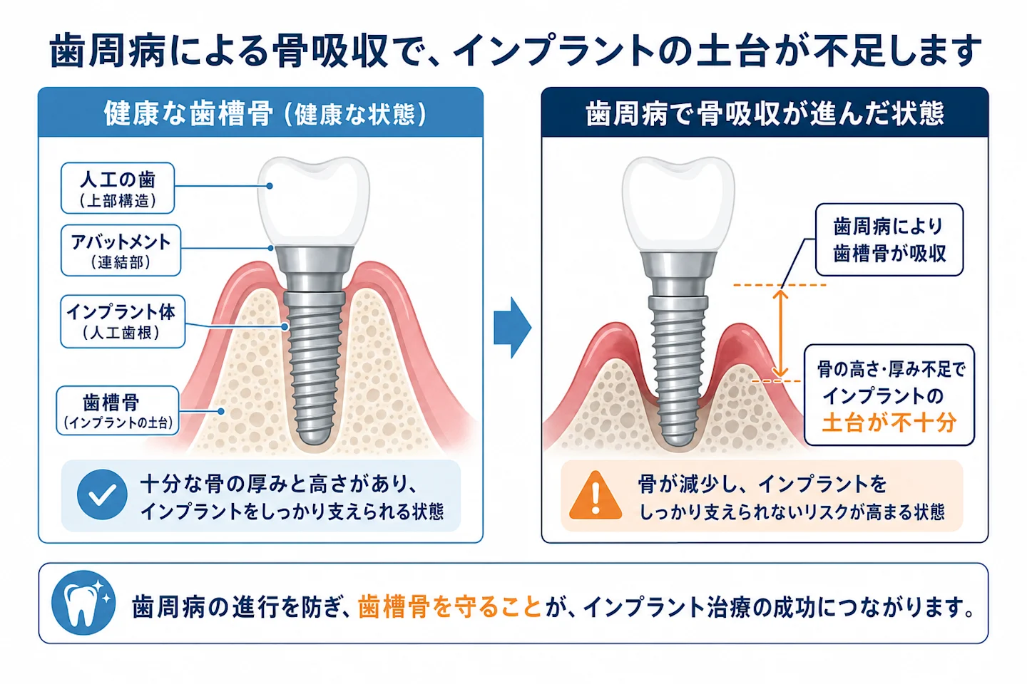 歯周病による骨吸収でインプラントの土台となる歯槽骨が不足する様子を示す比較図