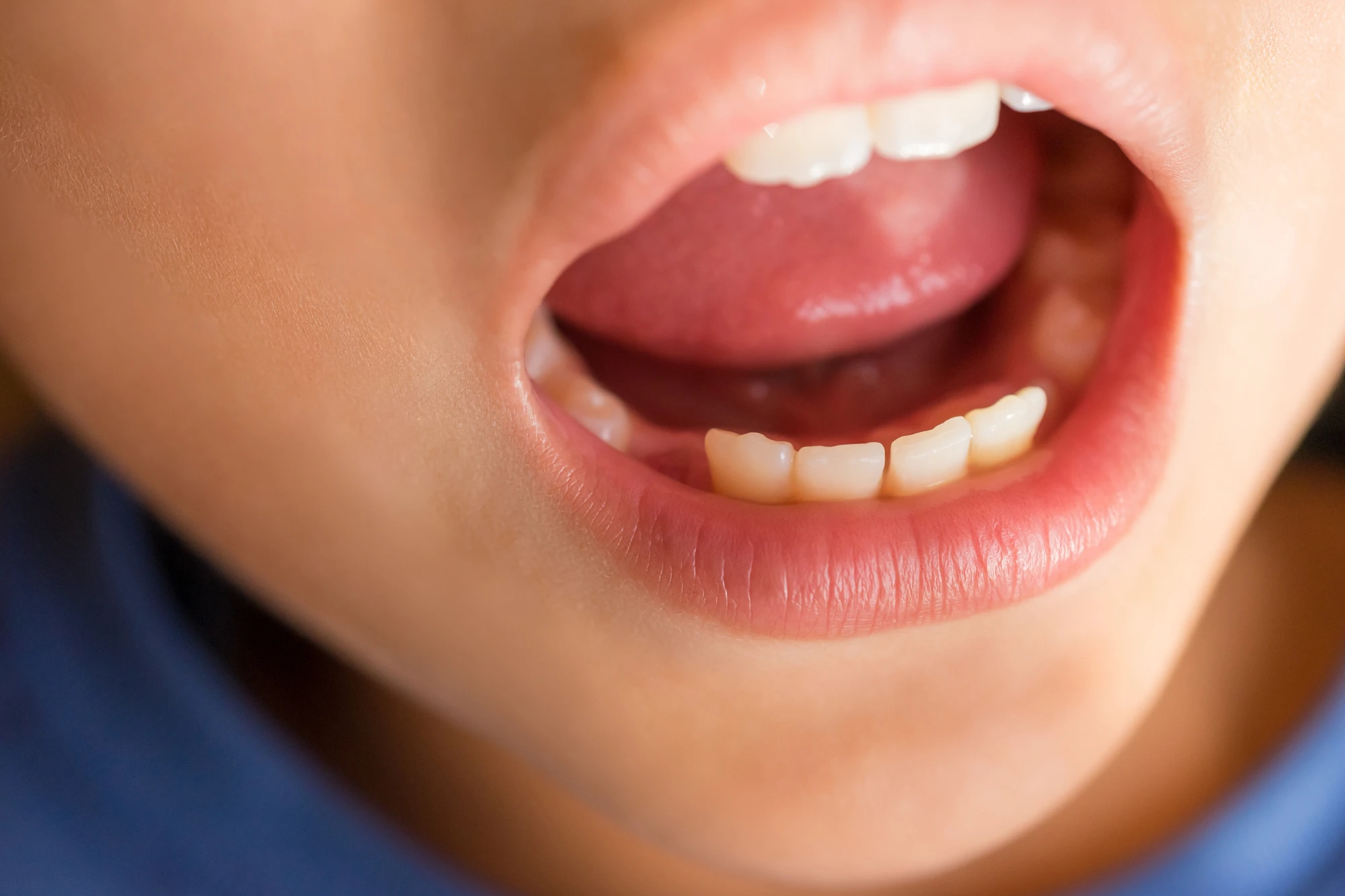 子供の時から出っ歯の場合の原因5つ