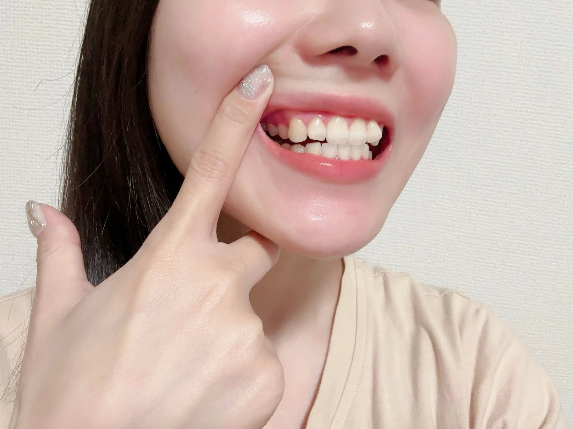 二重歯列とは
