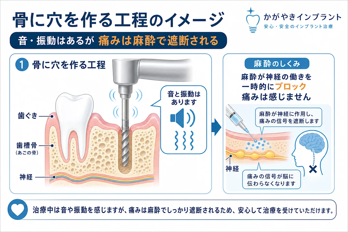 骨を削る音と振動はあっても麻酔で痛みは感じない仕組みを示す図解