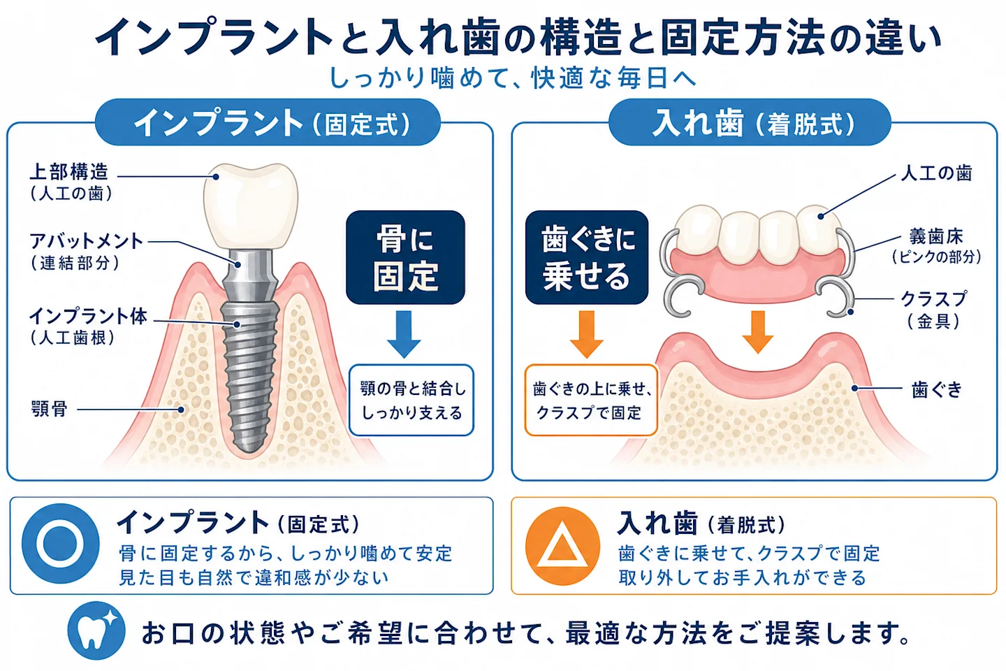 インプラントと入れ歯の構造と固定方法の違いを示す断面比較図