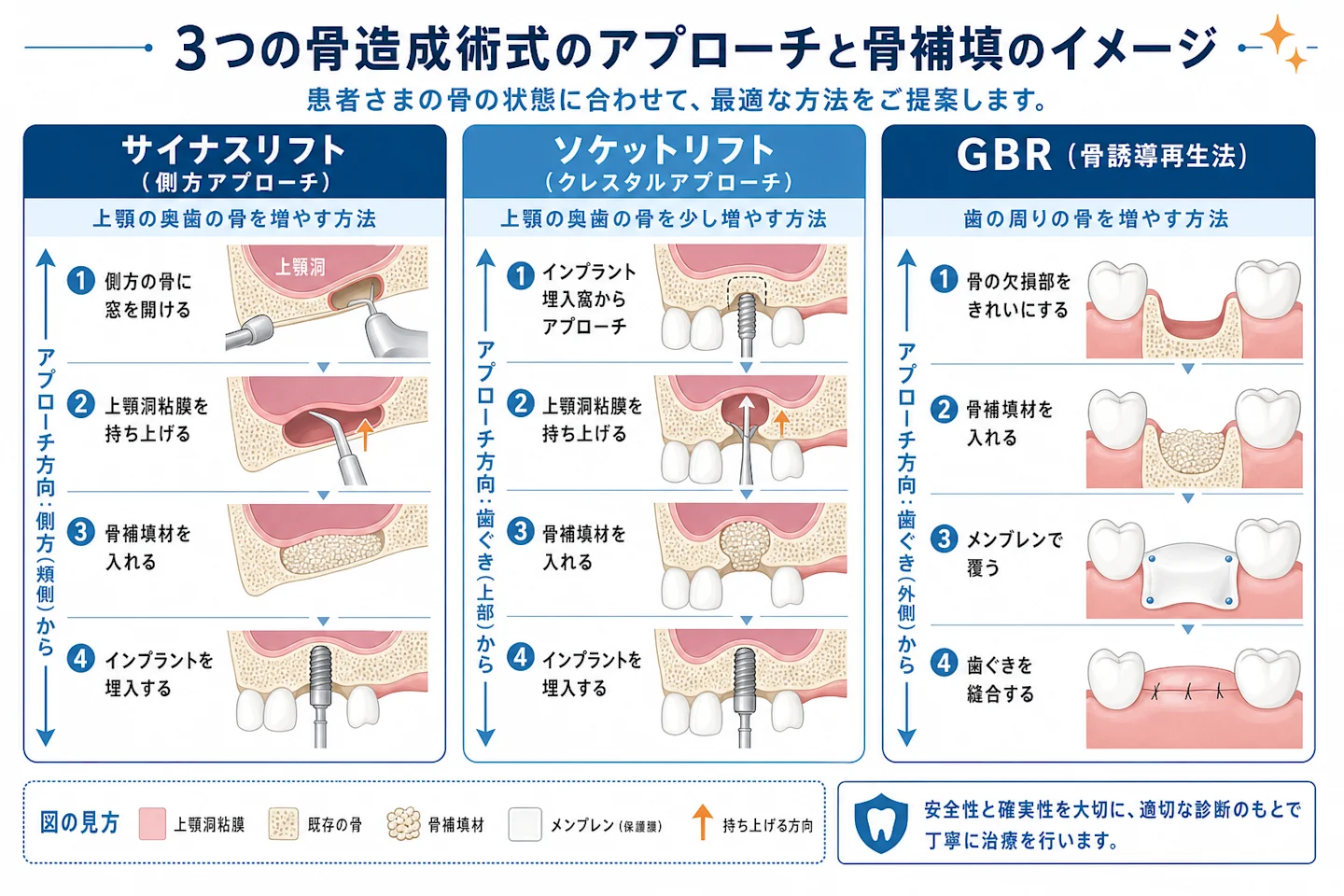 サイナスリフト・ソケットリフト・GBRの手術方法を比較したイラスト図解