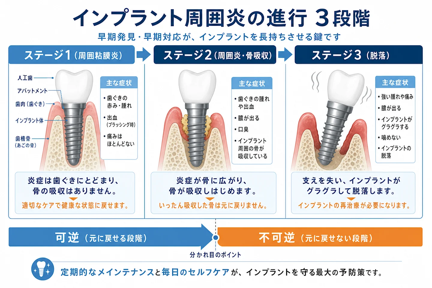 インプラント周囲炎の進行3段階(粘膜炎→周囲炎→脱落)を示す断面図解