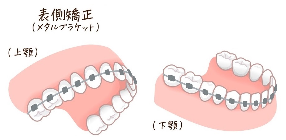 表側矯正の画像