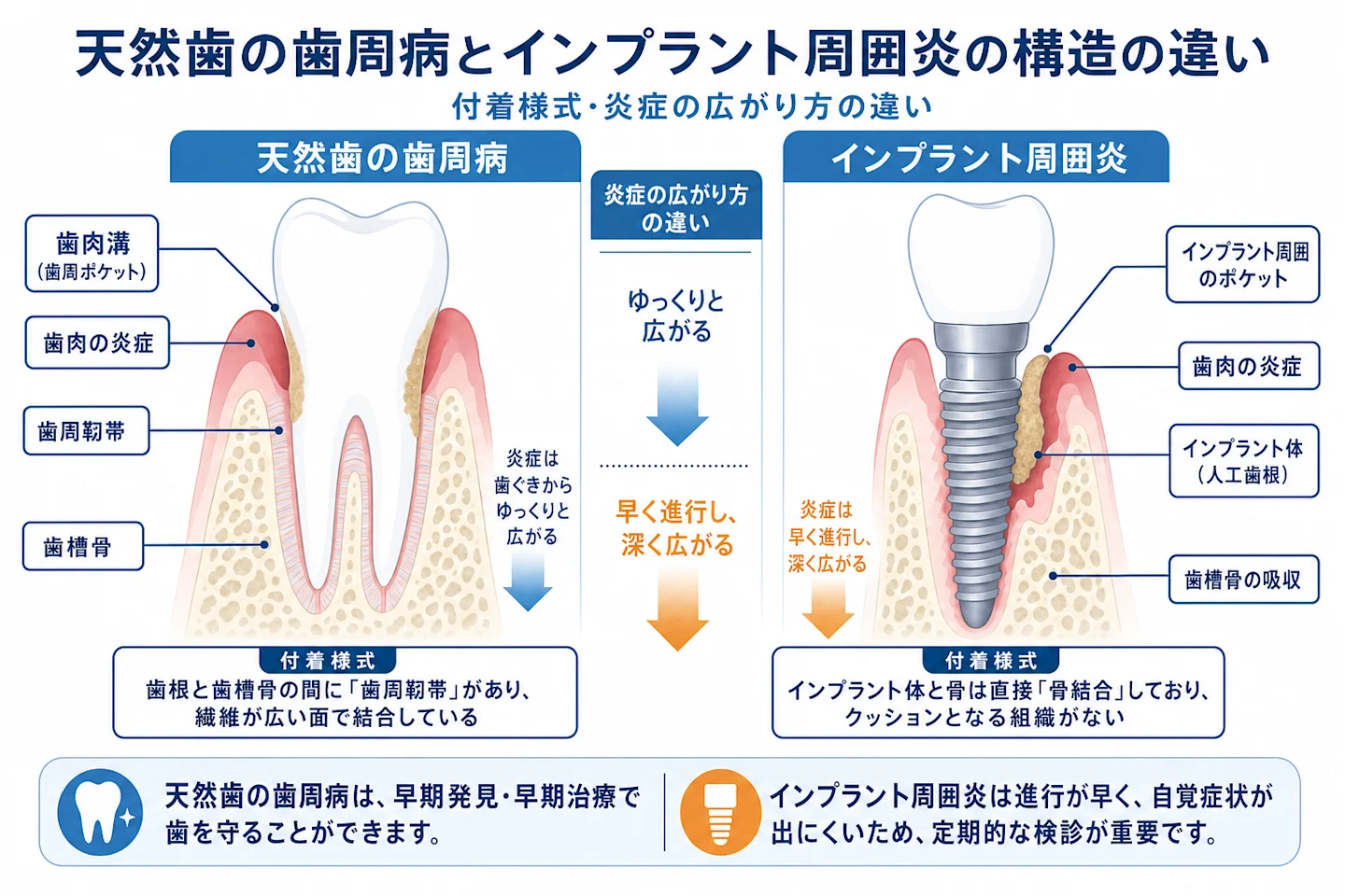 天然歯の歯周病とインプラント周囲炎の違いを比較した断面イラスト