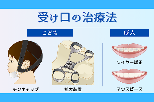 受け口の治療法