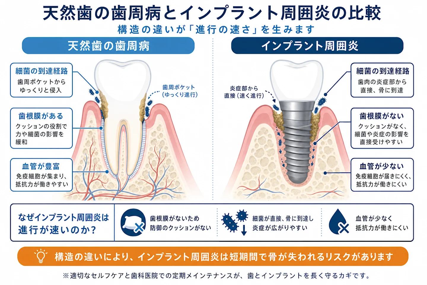 天然歯の歯周病とインプラント周囲炎の断面構造の違いを示す比較図