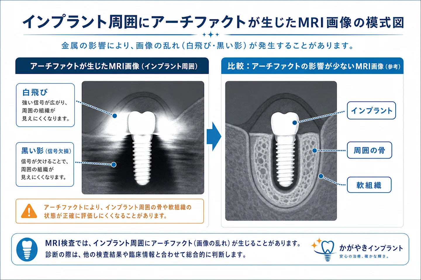 インプラント周囲にアーチファクト(画像の乱れ)が生じたMRI画像の模式図