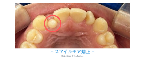 矮小歯の画像