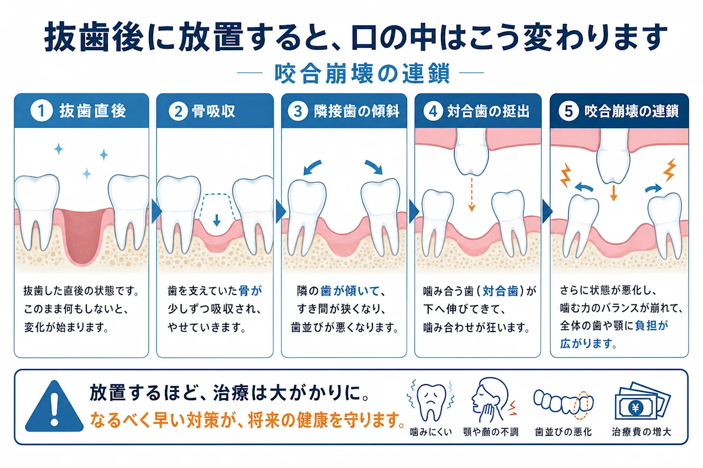 抜歯後に放置した場合の骨吸収・歯の傾斜・対合歯の挺出が進行する経時変化の図解