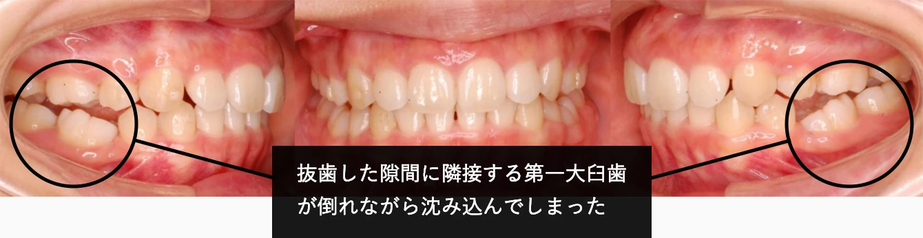 マウスピース矯正で悪くなった嚙み合わせ