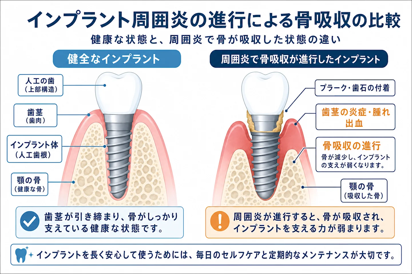 健康なインプラントと周囲炎で骨が吸収したインプラントの断面比較図