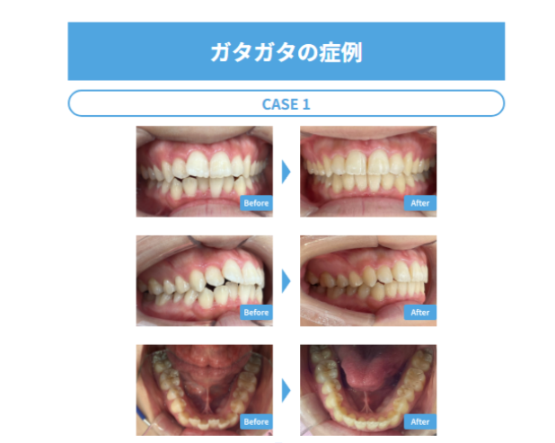 インビザライン治療事例