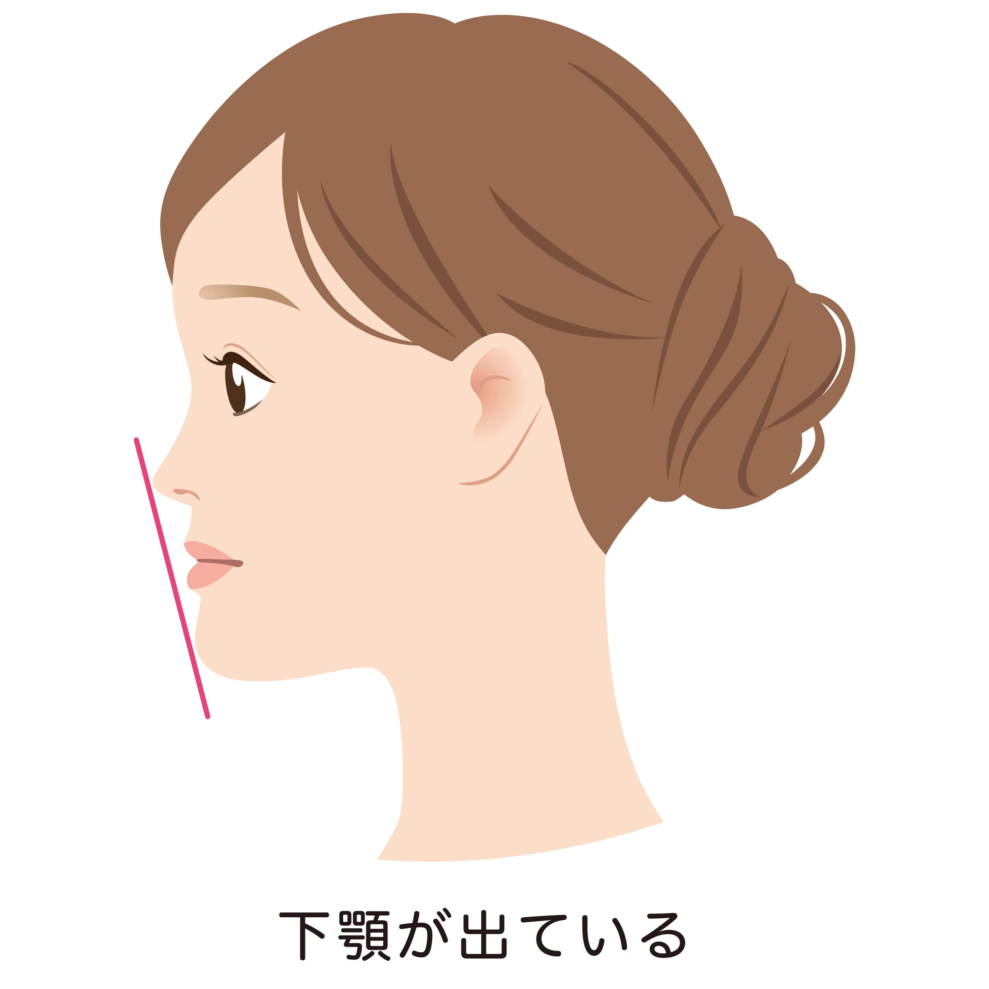 下顎前突とは？