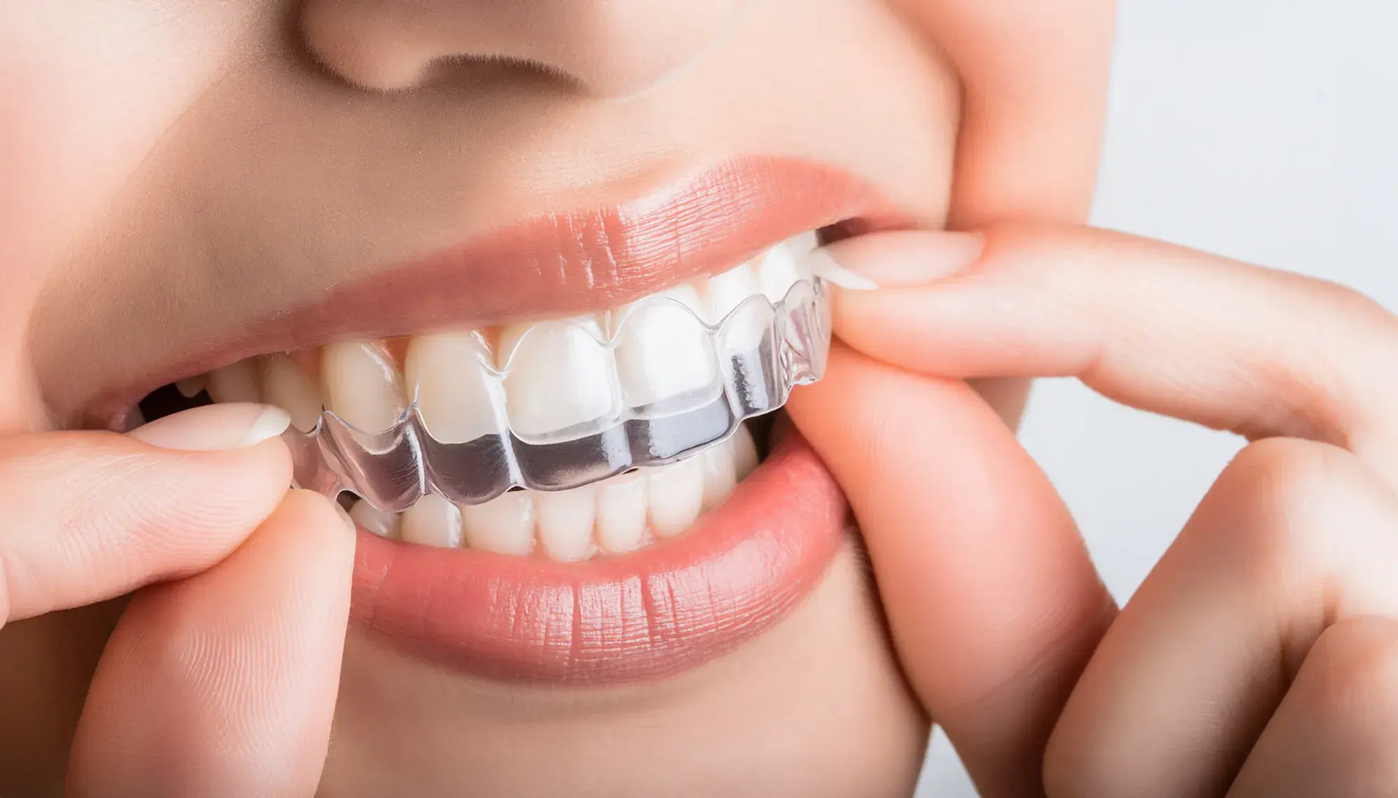 マウスピース矯正をした芸能人たちの実例紹介