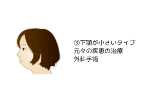 下顎が小さいタイプの口ゴボ