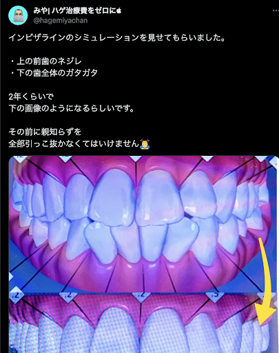 インビザライン治療計画の口コミ２