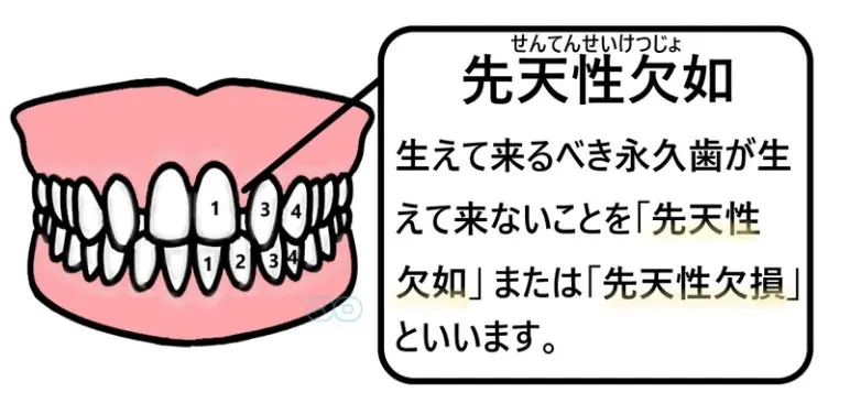 矮小歯がよく現れる場所