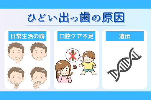 ひどい出っ歯の原因