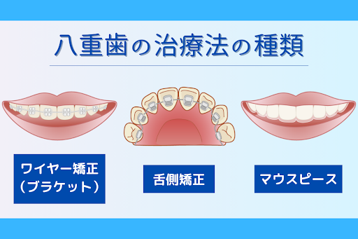 八重歯の治療法の種類
