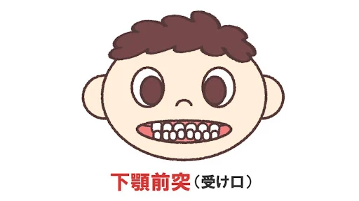 受け口のイラスト