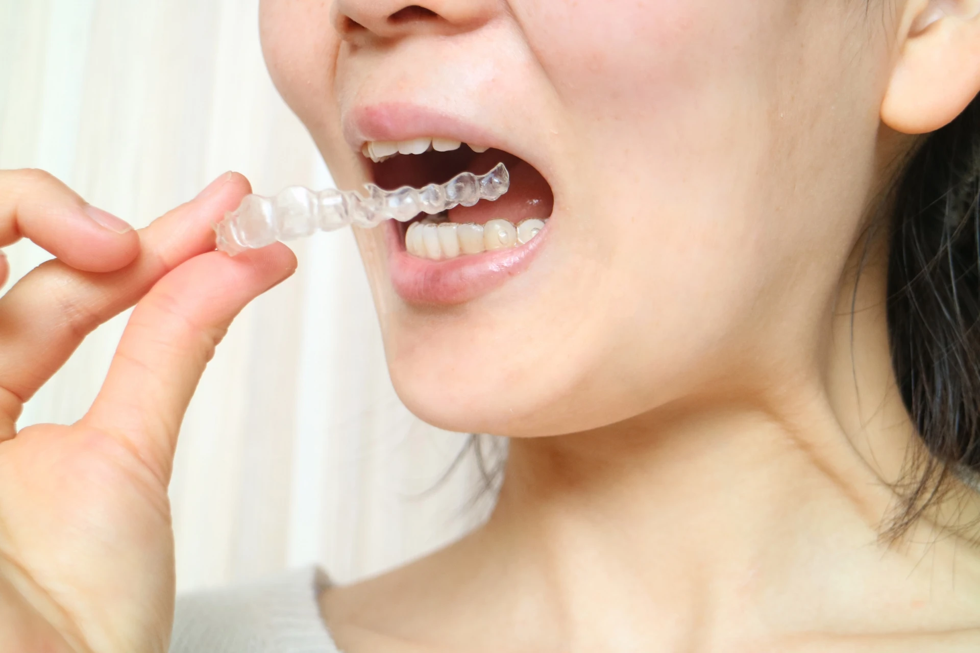 八重歯を抜歯しないで矯正する方法とは
