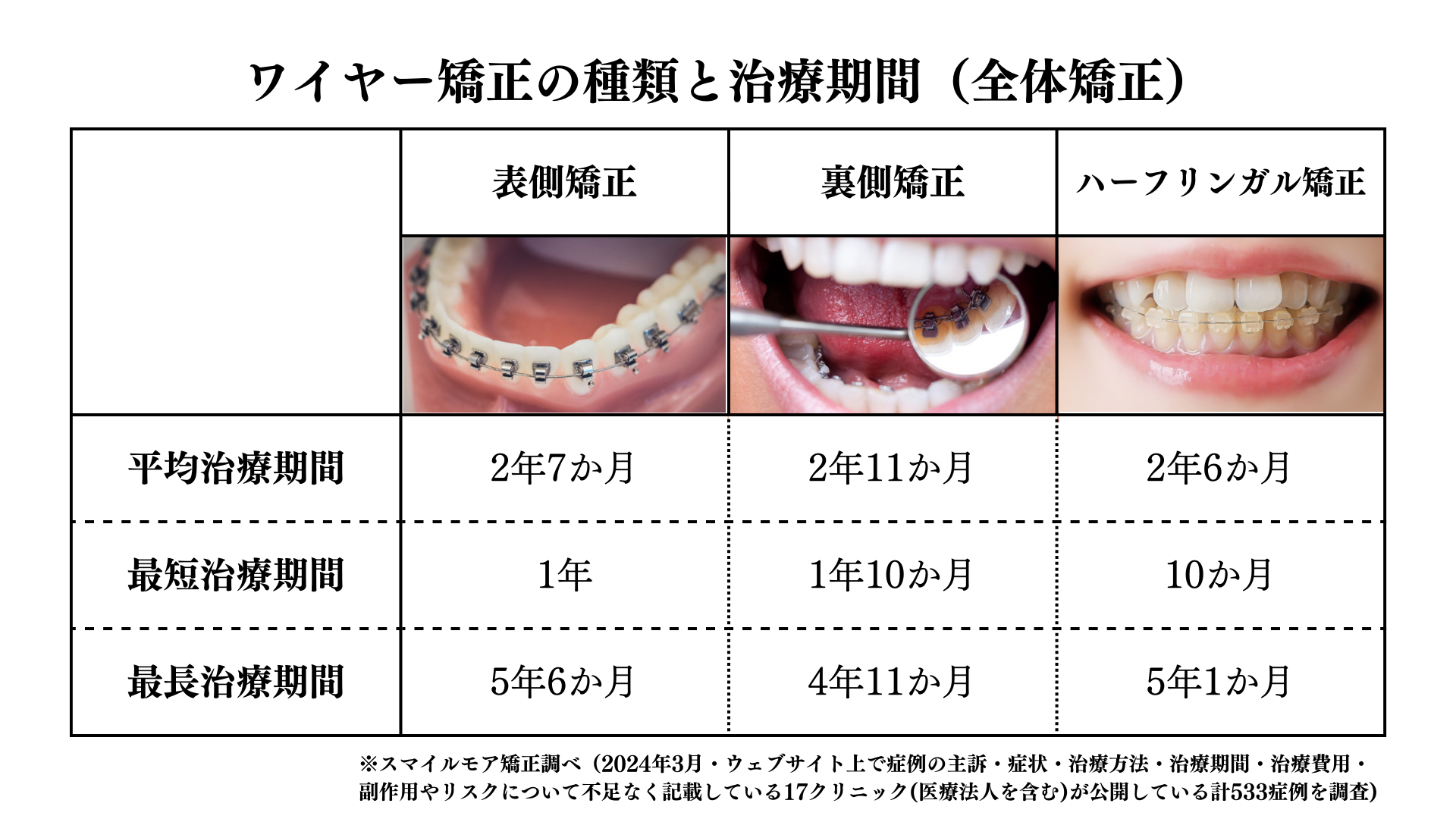 ワイヤー矯正の種類と治療期間（全体矯正）