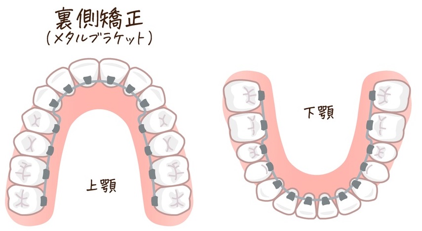 裏側矯正の画像