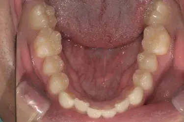 Before Image