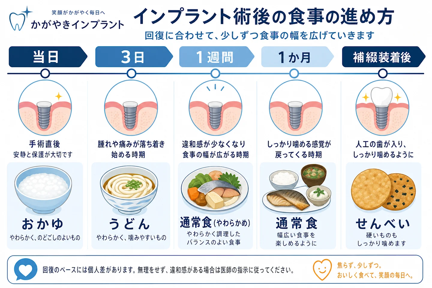 インプラント術後の食事解禁を示す時期別タイムライン図(当日から補綴装着後まで)