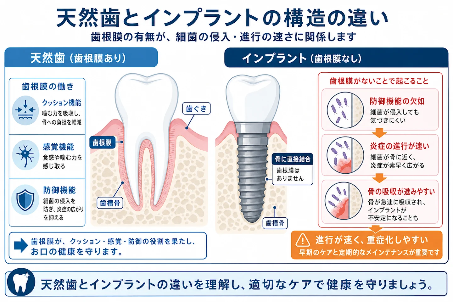 天然歯とインプラントの構造の違いを示す断面比較図(歯根膜の有無)