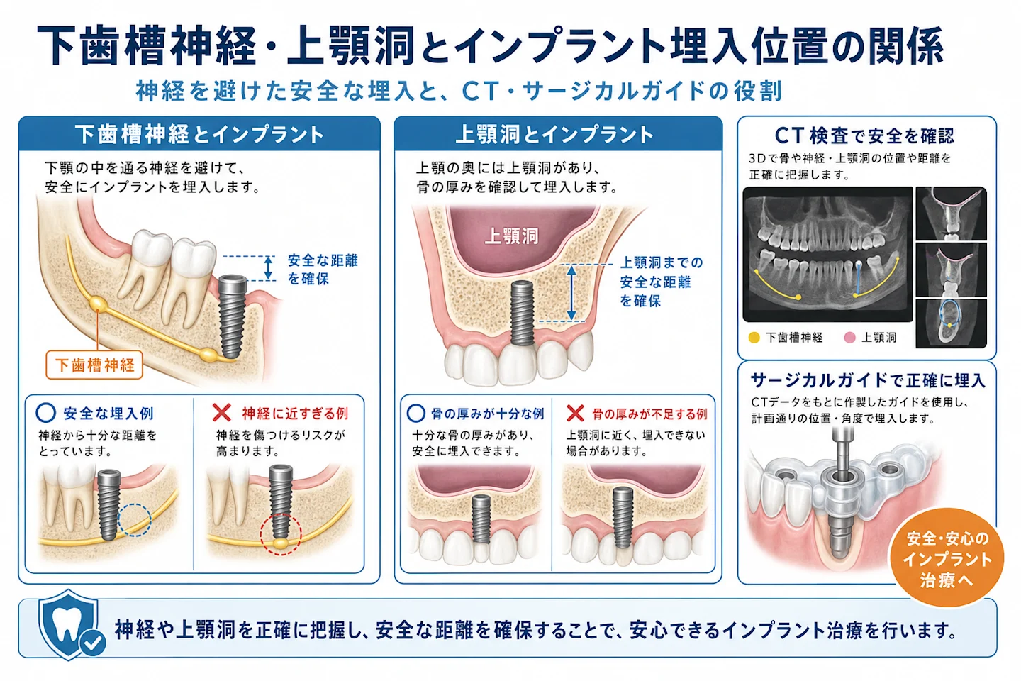 下歯槽神経とインプラント埋入位置の関係およびCT検査による安全確認を示す図