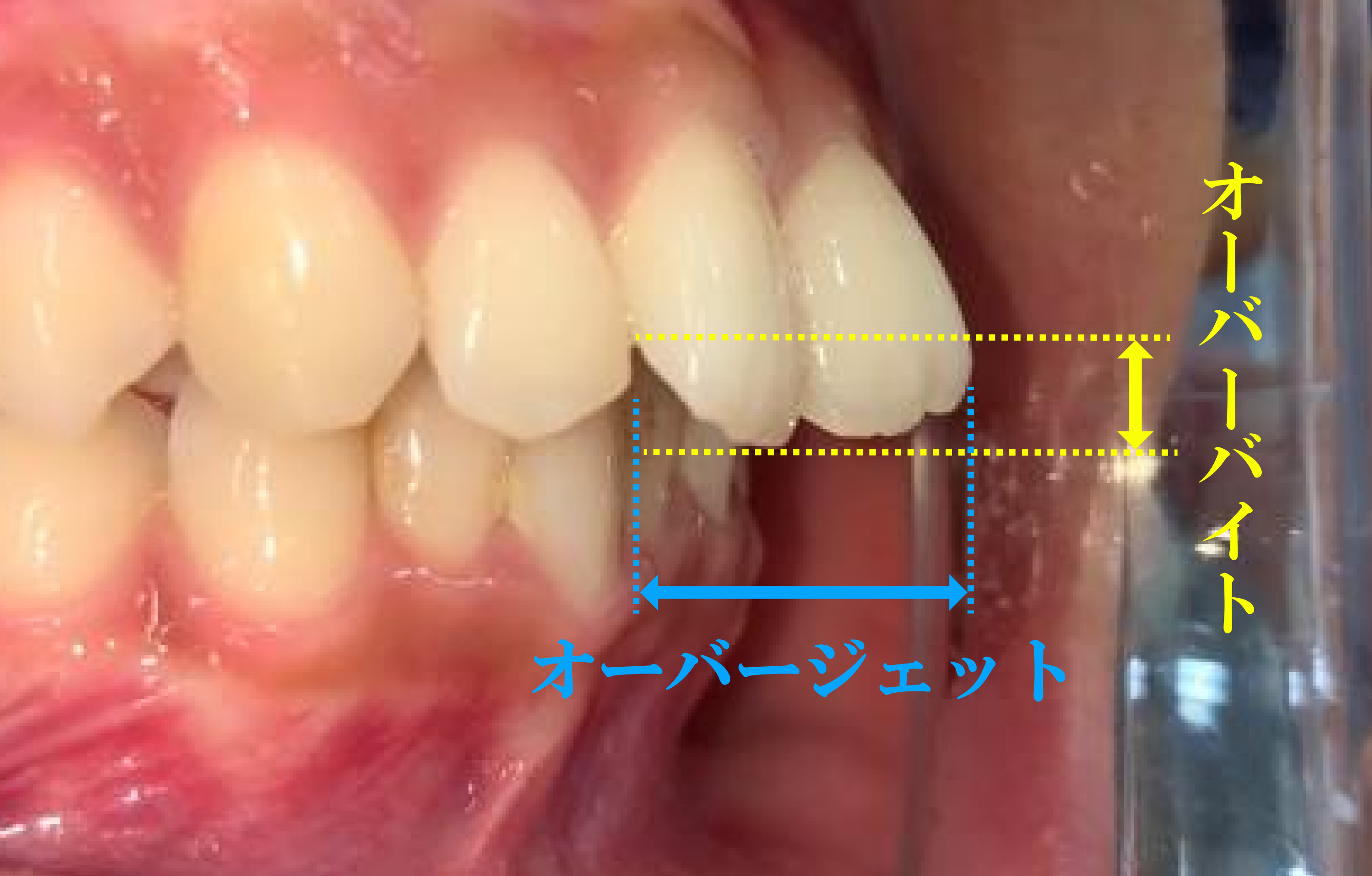 オーバージェットとオーバーバイトの説明画像