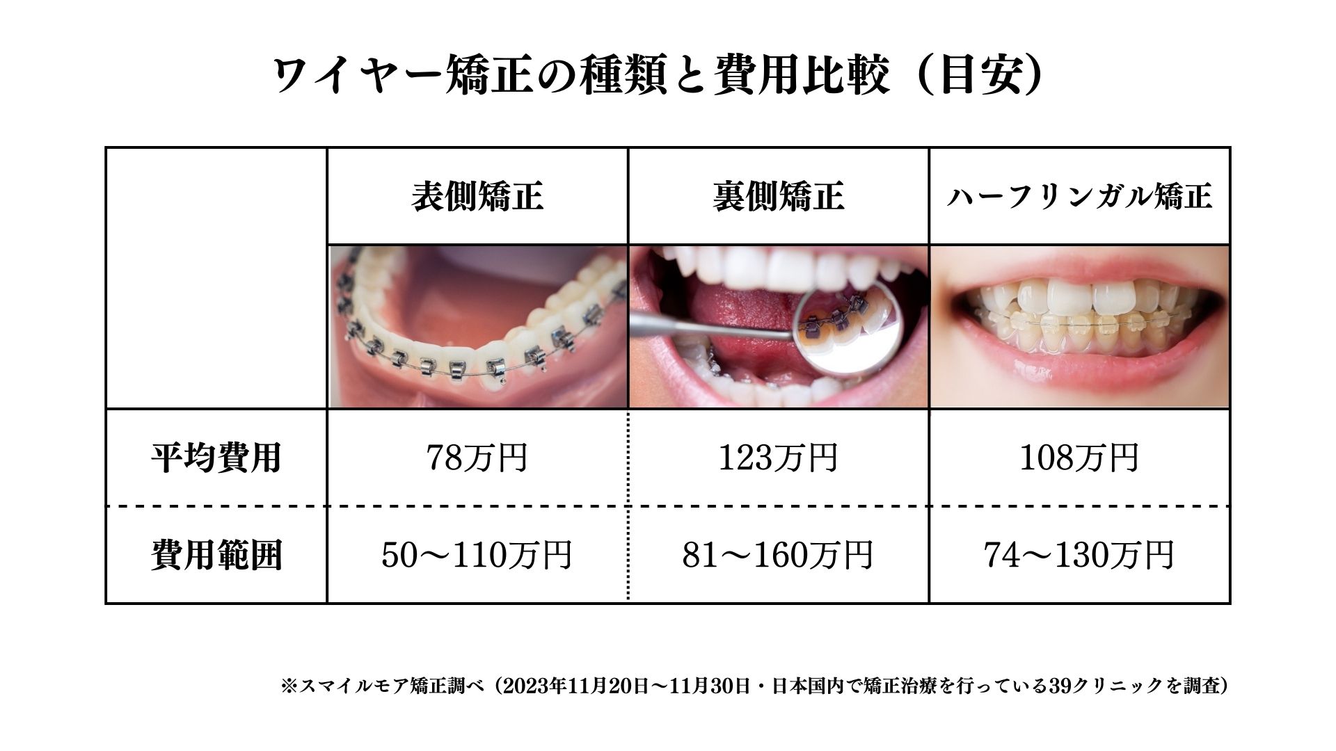 ワイヤー矯正の種類と費用比較（目安）