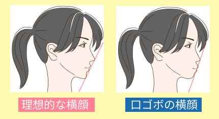 理想的な横顔と口ゴボの横顔の比較
