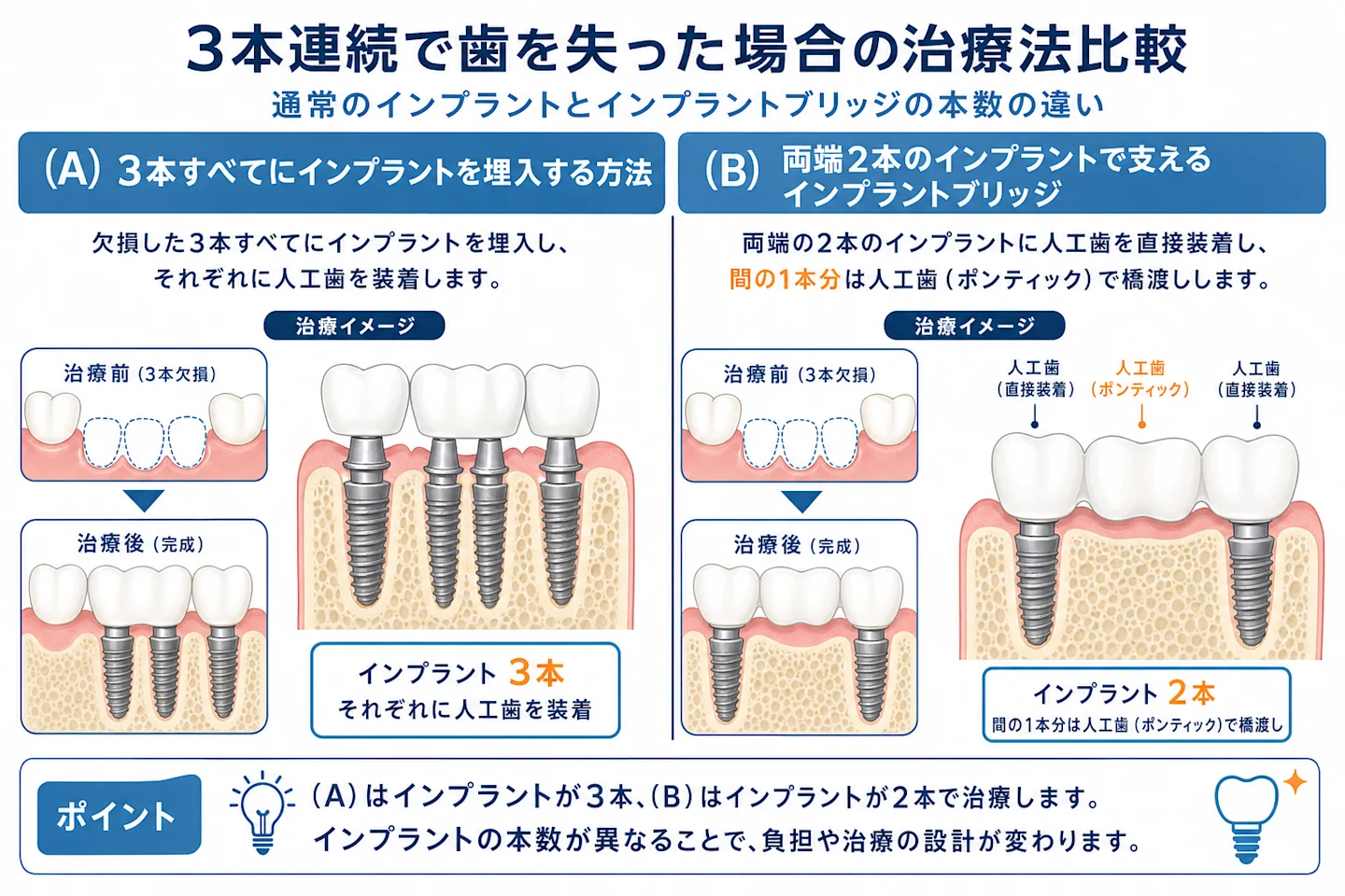 3本欠損に対する通常のインプラントとインプラントブリッジの本数の違いを示す比較図