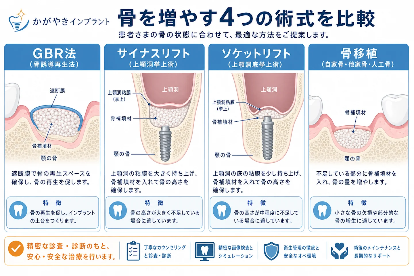 GBR法・サイナスリフト・ソケットリフト・骨移植の術式を比較した解剖イラスト図解