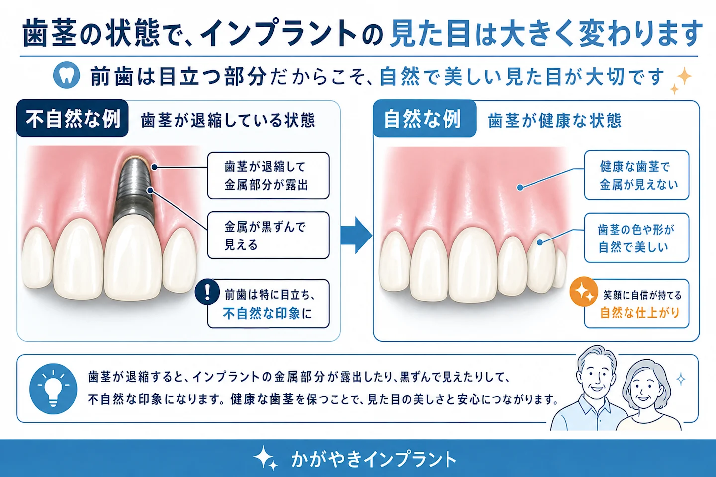 歯茎退縮による金属露出でインプラントが不自然に見える例と自然な例の比較図