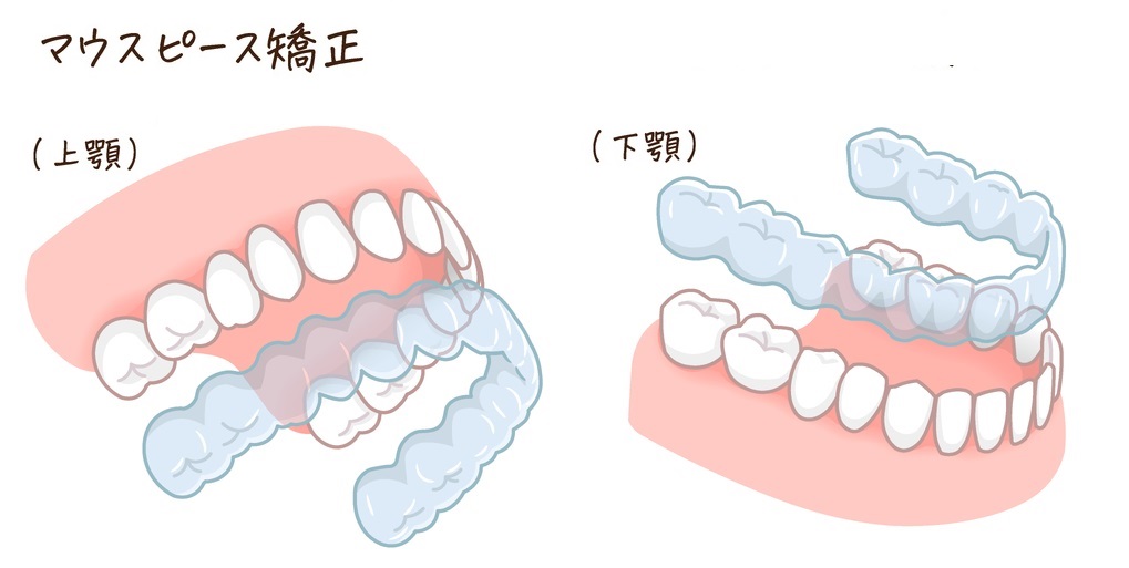 マウスピース矯正の画像